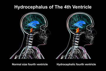 Canvas Print - Enlargement of the fourth brain ventricle, 3D illustration