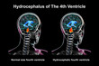 Enlargement of the fourth brain ventricle, 3D illustration