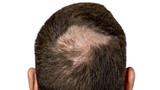 Fototapeta Do pokoju - Person with Hair Loss problems closeup. Alopecia Balding Hairs on man Scalp. Human Alopecia or Hair Loss. Scratching his Head. Baldness. Depression, Stress. PNG Design Element.
