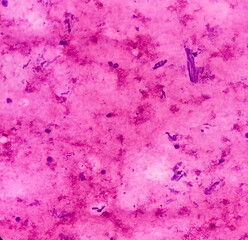 Canvas Print - CT guided FNA from abduminal mass: Spindle cell neoplasm, smear show cellular material of oval to spindle shaped cells, mild pleomorphism, blood.