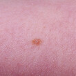 Mole or nevus on a child's skin