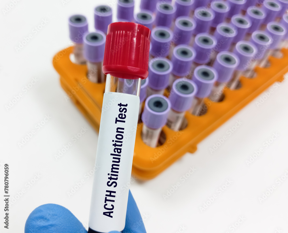Blood samples for ACTH Stimulation test. short Synacthen test. Before ...
