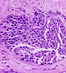 Canvas Print - Urinary bladder cancer. Transitional cell carcinoma. show malignant neoplasm, 40x view.