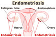 Endometriosis labeled diagram Human anatomy PNG