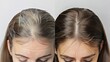 A woman is shown before and after receiving hair loss treatment. The background is a solid gray.