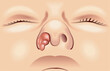 Medical illustration of a nasal tumor.