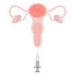 IUI treatment, Intrauterine insemination, Donor sperm service. The planing pregnant Illustration with egg cell, sperm cell good for poster medical clinic. Intrauterine insemination IUI