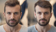 © Abdulla - Man's Hair Transplant Journey: A Visual Before & After Transformation