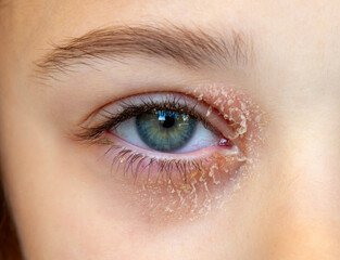 Eye of a little girl suffering from ocular atopic dermatitis or eyelid eczema.