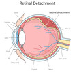 human eye anatomy showcasing retinal detachment, including cornea, lens, and optic nerve structure diagram hand drawn schematic vector illustration. Medical science educational illustration
