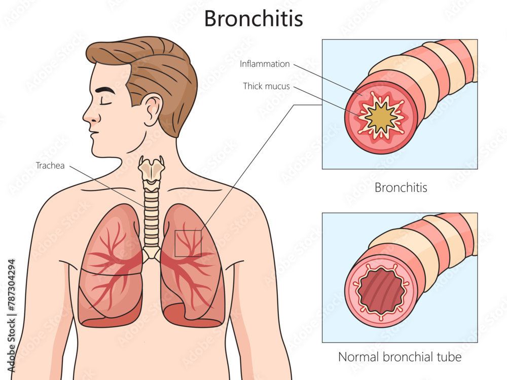 Bronchit Healthy and bronchitis affected bronchial tubes, with a focus on ...