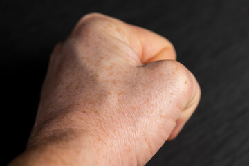 part of a man's hand with freckles