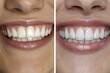 © LimeSky - Before and after smile transformation with gummy smile correction and ceramic veneers