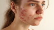 Irritated skin with red and swollen acne spots, depicting the discomfort of active breakouts