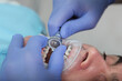 Separation of teeth. Grinding of tooth enamel. Correction of the dentition. Braces on the teeth. Modern dentistry.