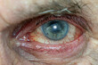 © fotosenukas - Close-up of an adult man's eye after surgery