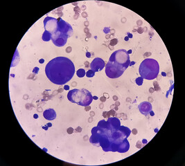 Canvas Print - Malignant fluid cytology; Cells of adenocarcinoma may spread to fluid of pleural or peritoneal cavity in cancer from the breast, lung, colon, pancreas, ovary, endometrium or other sites.