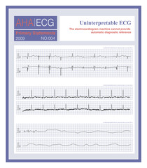 Wall Mural - When the ECG is too complex, the recording quality is poor, or it is impossible to interpret what is causing the loss of the ECG, the ECG machine will not be able to provide a diagnostic reference.
