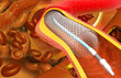 Angioplasty stent on scientific background. 3d illustration..