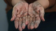 © john - Dry hands peeling skin on hand and fingers. air allergy, chemical allergy