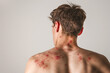 © Marina Demidiuk - Male Back with Painful Rash, Red Spots Blisters on the Skin. Human Body with Health Problem. Monkeypox, Monkey Pox Disease Symptoms. Close Up Patient. Banner, Copy Space. Dengue Fever Infection, MPOX.
