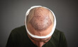 Caucasian man after hair transplantation.