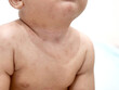 Baby girl with red rash on her skin, measles or chicken pox on newborn
