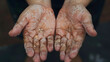 Dry hands peeling skin on hand and fingers. air allergy, chemical allergy.Dermatitis. 