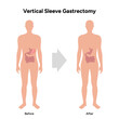 Vertical Sleeve Gastrectomy before and after, Gastric