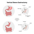 Vertical Sleeve Gastrectomy before and after