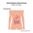 Vertical Sleeve Gastrectomy Weight loss surgery 