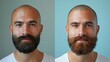 © DZMITRY - The transformation of a happy guy with a beard and without hair loss. Before and after shave or hair transplant.