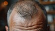 Hair loss, alopecia, and transplantation concept for a barber shop.