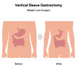 Vertical Sleeve Gastrectomy before  and after