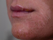 CLOSE UP, DOF: Facial skin of a young woman showing signs of severe inflammation. Lady with a damaged epidermis on her face suffers from itchy and irritated red skin caused by an allergic reaction.