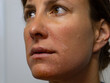 CLOSE UP, PORTRAIT: Young woman with severe sunburns on her face after sunbathing. Careless lady forgot to apply sunscreen before going out in the sun, which resulted in reddened and burnt facial skin