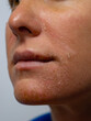CLOSE UP, PORTRAIT: Unhealthy reddened and flaky skin on the face of young woman. Lady with a damaged epidermis on her face suffers from itchy and irritated red skin caused by extreme sun exposure.