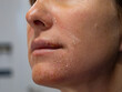 CLOSE UP, PORTRAIT: Young woman with an unhealthy reddened and flaky facial skin. Peeling skin on face of a lady with signs of severe inflammation and allergic reaction to dangerous sun exposure.