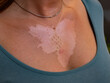 CLOSE UP, DOF: Peeled skin on the neck of a young woman after dangerous sunburn. Unhealthy red burnt skin with visible white necklace pendant mark after careless and excessive exposure to summer sun.