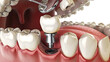 a dental implant procedure. It focuses on human teeth and gums, with two holes prepared for implant