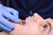 Braces on the teeth. A device for correcting the position of teeth. Alignment of the dentition. Orthodontic treatment. Close-up of the dentist's hand.