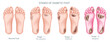 Diabetic foot refers to a group of complications that can arise in the feet of individual with diabetes mellitus. Peripheral arterial disease poor circulation of blood to the limbs vector illustration