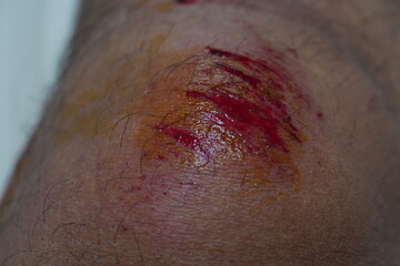 wound on knee.