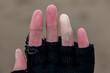 A hand of a Raynaud's phenomenon sufferer, with one finger white through poor circulation