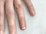 Fototapeta Tulipany - female hand with brittle fingernail. Fungal infection
