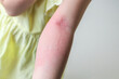 Little girl has skin rash allergy and itchy on her arm