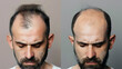 © Prasanth - Comparison of hair loss treatment in men before and after – a visual journey to success