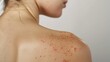 © JovialFox - Closeup young woman's back with red rash skin and acne scar  shoulder and back. Image compare before treatment on dark spot acne pimples scar to clean clear smooth skin after treatment.