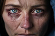 © XaMaps - A close-up of a woman with a bruised eye looking directly into the camera.