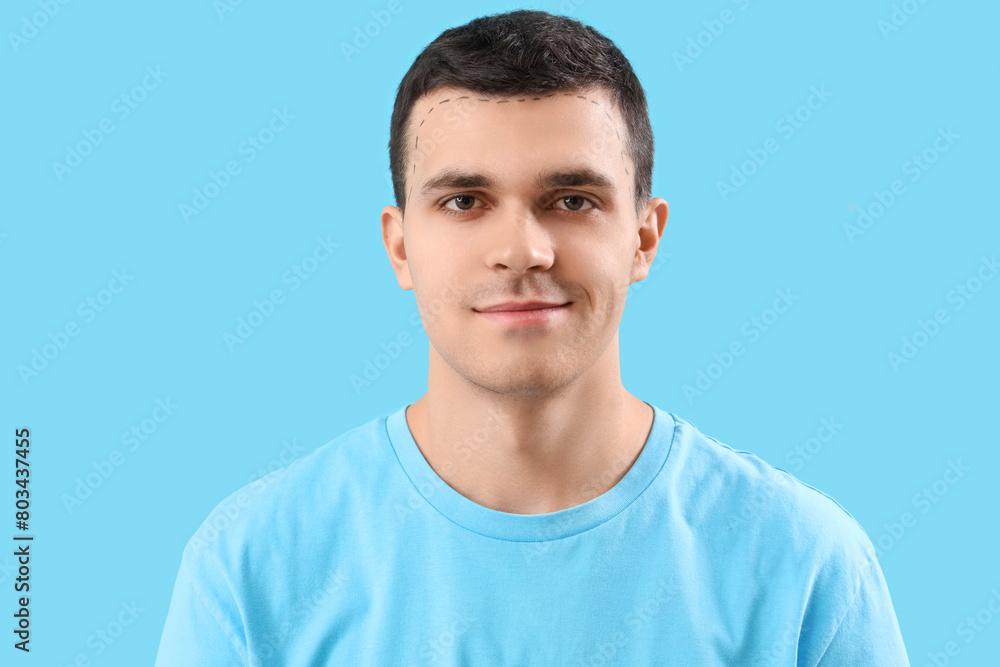 Young man with hair loss problem and marked head on blue background, closeup